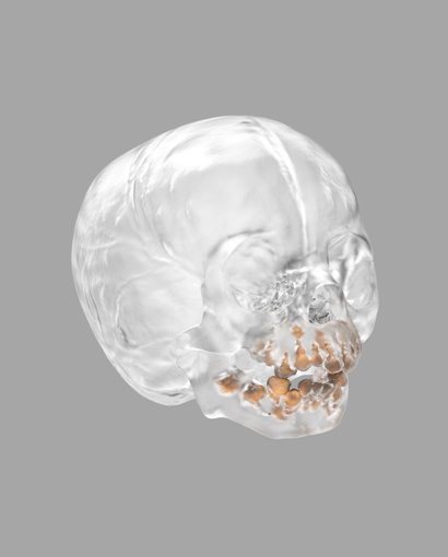 Accura ClearVue (SLA)